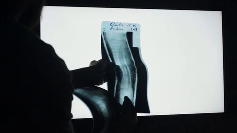 The doctor is looking x-ray image of bones fracture Stock Footage 113190652