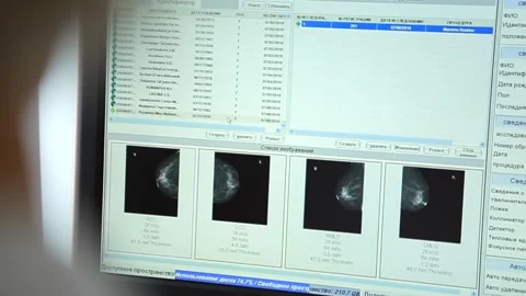 Doctor looking at x-rays of the breast on the screen Video stock 168569488