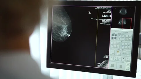 Doctor looking at x-rays of the breast on the screen Stock Footage 168569517