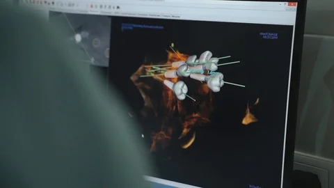 The doctor looks on three-dimensional computer model of dental implants Stock Footage 116814398