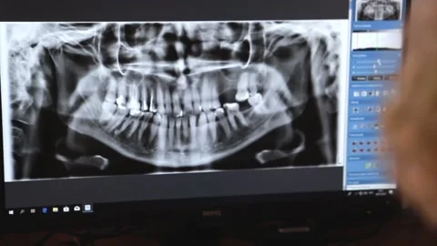 The doctor looks at x-rays of teeth on the screen Stock Footage 168569397
