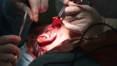 Doctor makes nodules while stitching tissue on a person's face 스톡 동영상 123569199