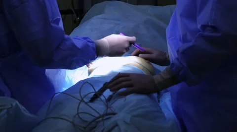 The doctor makes an operation Vídeo Stock 61105405