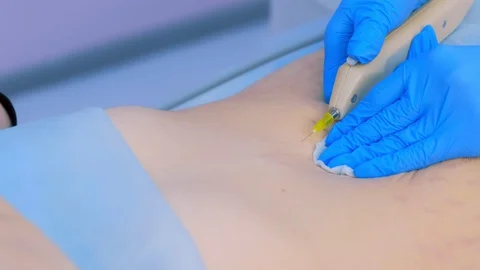 Doctor making injection of carbon dioxide on patient abdomen on carboxytherapy. Stock Footage 129612546
