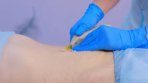 Doctor making injection of carbon dioxide on patient abdomen on carboxytherapy. Stock Footage 129613368