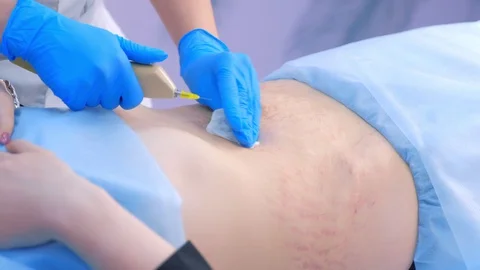 Doctor making injection of carbon dioxide on patient abdomen on carboxytherapy. Stock Footage 129614260