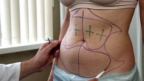 The doctor marks the liposuction Видео 158546959