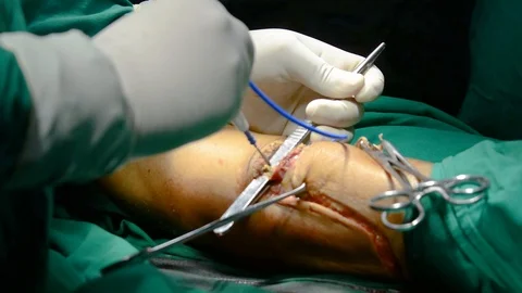 Doctor operating on leg Stock Footage 102781629