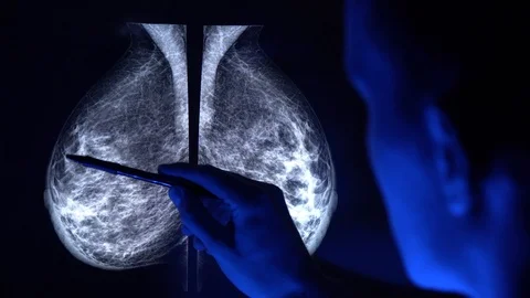Doctor with a pan checking mammogram x-ray. Video stock 112224228