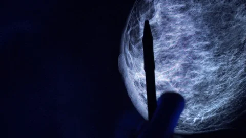 Doctor with a pan checking mammogram x-ray. Vidéo 112224246