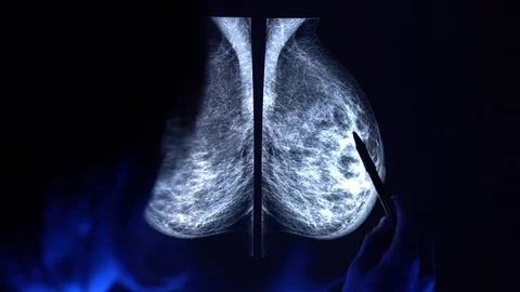 Doctor with a pan checking mammogram x-ray. Vidéo 112224267
