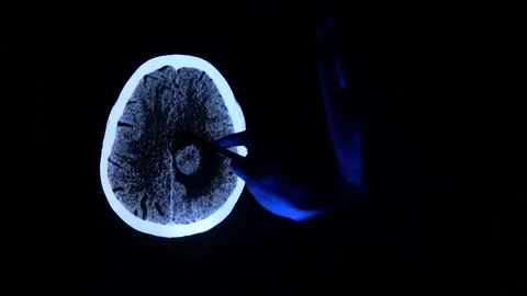 Doctor with a pen checking a tomography scan of a brain with cancer tumor Video stock 152513583