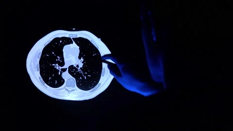 Doctor with a pen checking a tomography scan of lungs with cancer tumor 库存影片 152513586