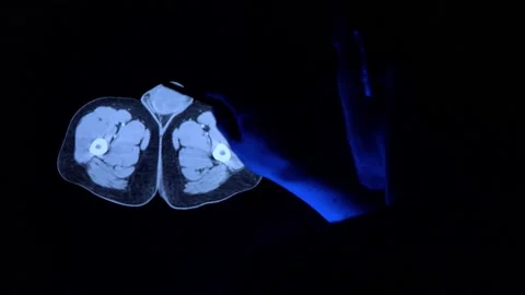 Doctor with a pen checking tomography scan of testicles with cancer tumor 库存影片 152513587