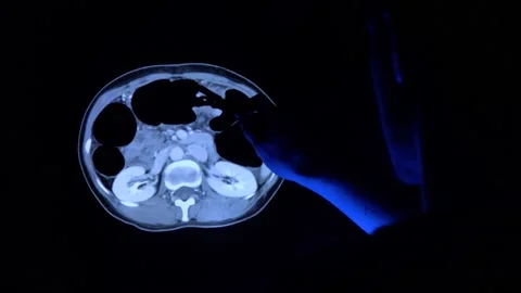 Doctor with a pen checking a tomography scan of a colon with cancer tumor 스톡 동영상 152687685