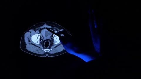 Doctor with a pen checking a tomography scan of a bladder with cancer tumor 動画素材 152687689