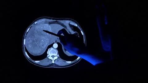 Doctor with a pen checking a tomography scan of a liver with cancer tumor Video stock 152687690