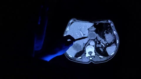 Doctor with a pen checking a tomography scan of a colorectal cancer tumor Vidéo 152687701