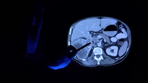 Doctor with a pen checking a tomography scan of the kidney with cancer tumor 库存影片 152687731