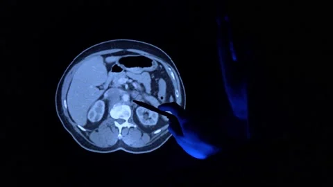 Doctor with a pen checking a tomography scan of the prostate with cancer tumor 库存影片 152687732