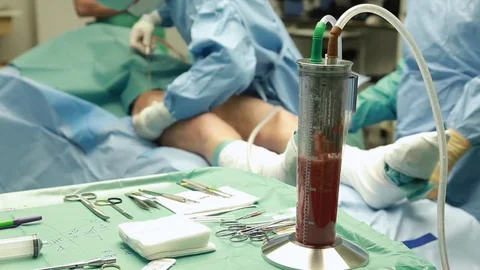 Doctor performing Liposuction Stock Footage 82874954