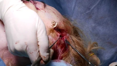 The doctor performs a facelift operation that sews up tightened elements 스톡 동영상 72568002