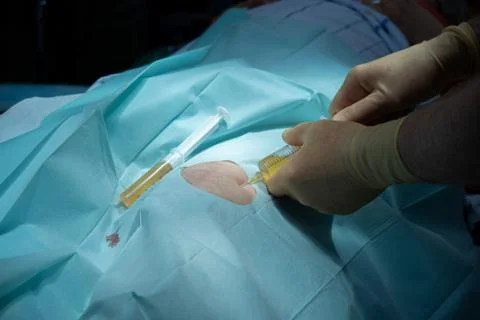 Doctor performs a knee puncture in an operating room with a cannula and a syr Stock Photos