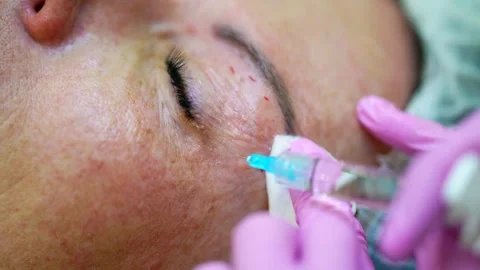 The doctor performs a micro rejuvenation procedure, the skin around the patient' Stock Footage 288613187