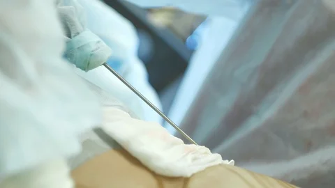 The doctor performs an operation of liposuction to a man. Gathers the fat of the Video stock 90800396