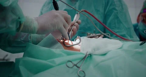 The doctor performs a pediatric surgical operation to remove the tonsils Stock Footage 163910675