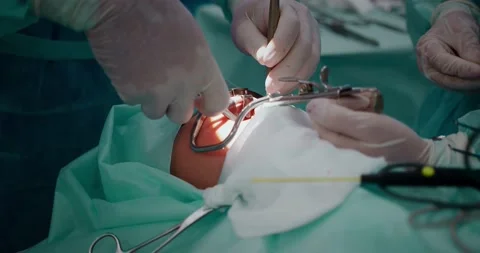 The doctor performs a pediatric surgical operation to remove the tonsils Stock Footage 163911538