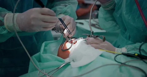 The doctor performs a pediatric surgical operation to remove the tonsils Stock Footage 163912660