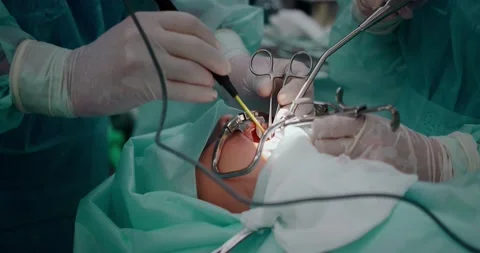 The doctor performs a pediatric surgical operation to remove the tonsils Stock Footage 163913608