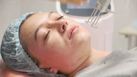 The doctor performs the procedure of lifting with a laser Stock Footage 145000066