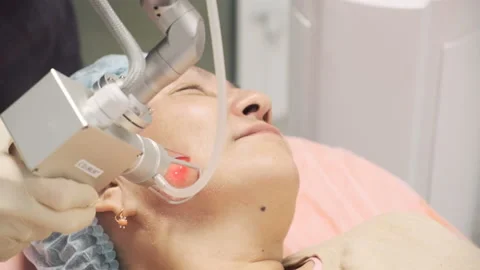 The doctor performs the procedure of lifting with a laser Stock Footage 145004875