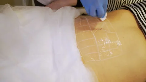 The doctor performs the smas lifting procedure Video stock 202608859