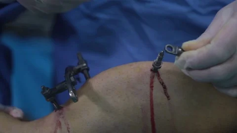 The doctor performs surgery to correct the curves of the leg bones of the patien Stock-Footage 73040018