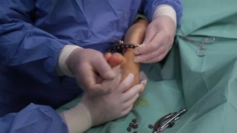 The doctor performs surgery to correct the curves of the leg bones of the patien Video stock 73040068