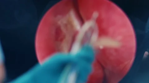 The doctor performs a surgical operation with a nasal endoscopy, close-up Stockbeeldmateriaal 230273675