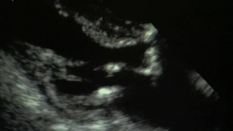 Doctor pointing at echocardiogram Stock Footage 78011976
