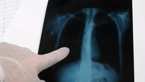The doctor points a finger  at the problem on X-ray shot of lungs. Stock Footage 134153493