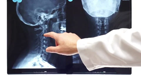 Doctor Points On Neck Xray Stock Footage