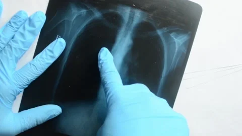 The doctor points out coronavirus problem on X ray shot of lungs. Stock Footage 154866404