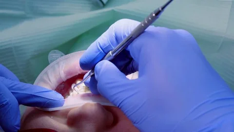 The doctor puts the thread to stop the bleeding between the tooth and gum of the Stock Footage 72462782