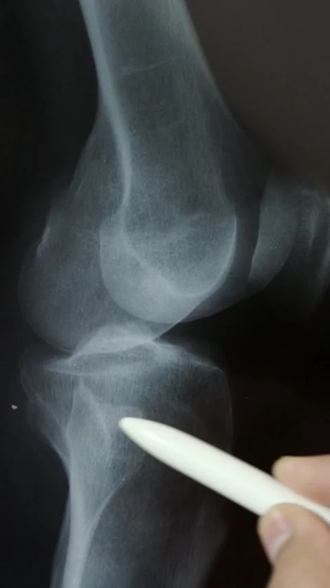 Doctor radiologically analyzing the knee with x-ray Vídeos de archivo 337033458