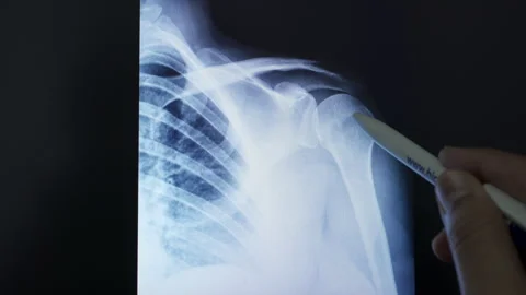 Doctor radiologically analyzing the shoulder joint to see injuries of tendons Vidéo 286232280