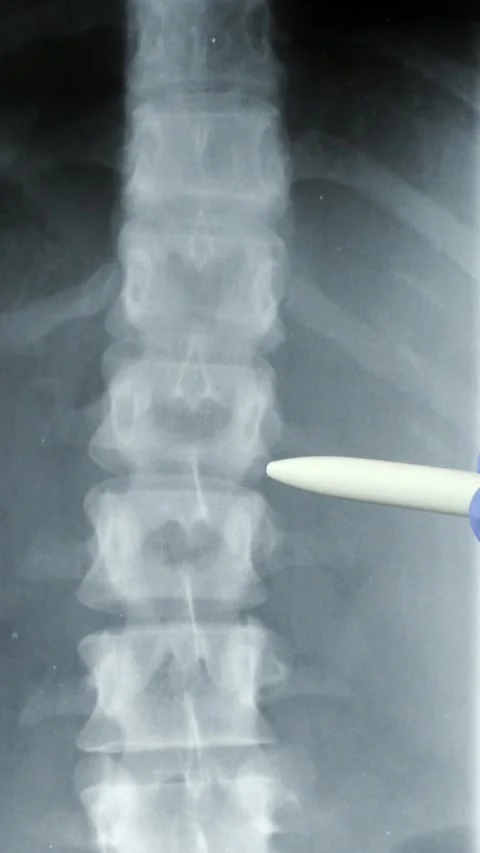 Doctor radiologically analyzing the spinal column with x-ray..Hand of a docto Vídeos de archivo 337033270