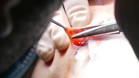 The doctor scissors separates the skin under the patient's eye during plastic Video stock 90823040