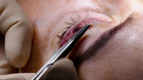 The doctor scissors separates the skin under the patient's eye during plastic Vidéo 105975411