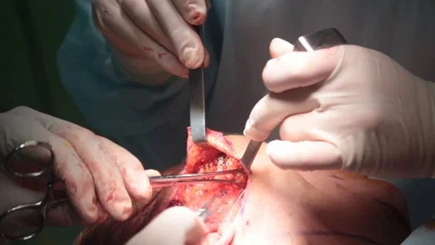 The doctor sews soft tissue on the face of a person 스톡 동영상 123569426